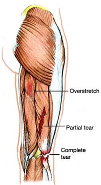 Hamstring Strain