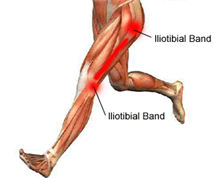 ILIOTIBIAL BAND SYNDROME