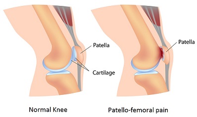 PATELLOFEMORAL PAIN SYNDROME