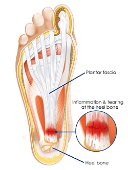 Plantar Fasciitis - inflammation of plantar fascia
